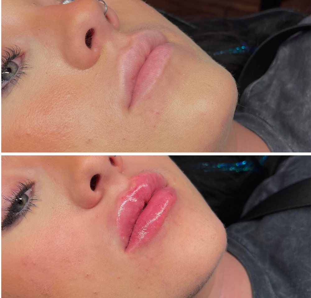 Hyaluron Lip Infusion 1ML