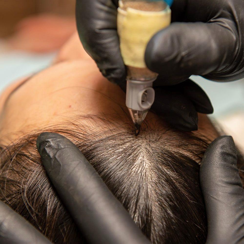 🎀SMP (Scalp Micropigmentation)
