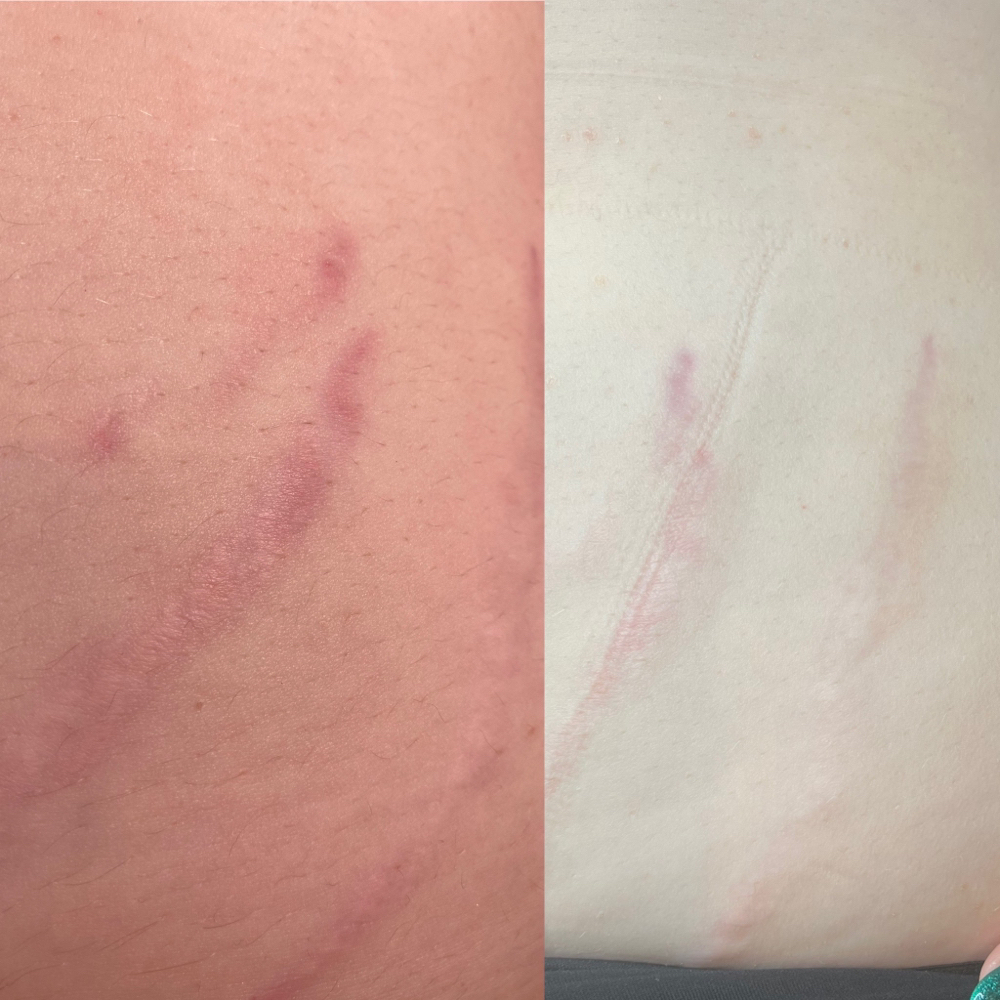 Stretch Mark - Body Microneedling