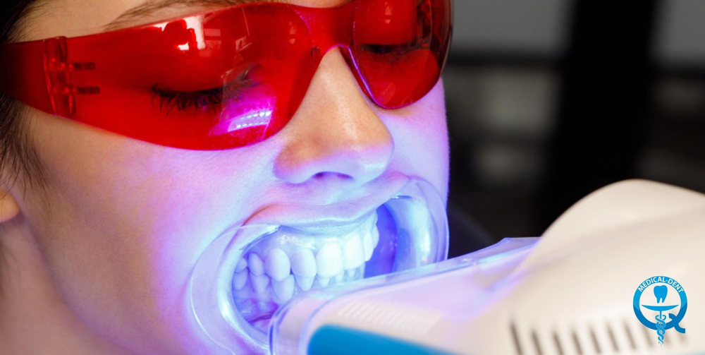 Teeth Whitening