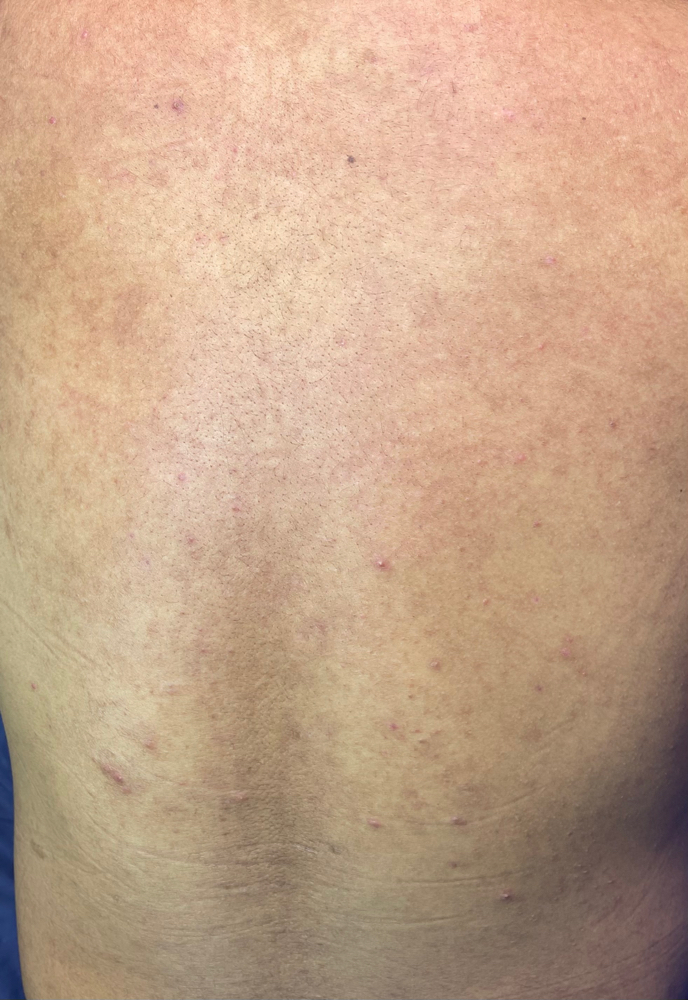 Back Facial