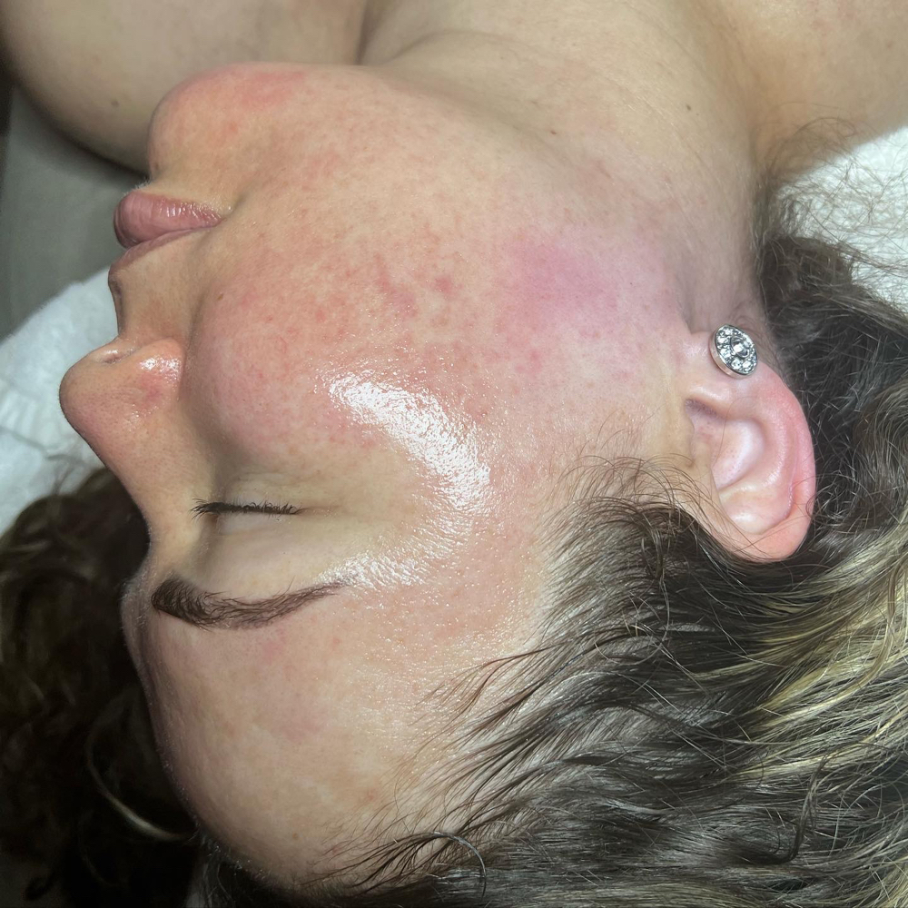 Dermaplaning Facial