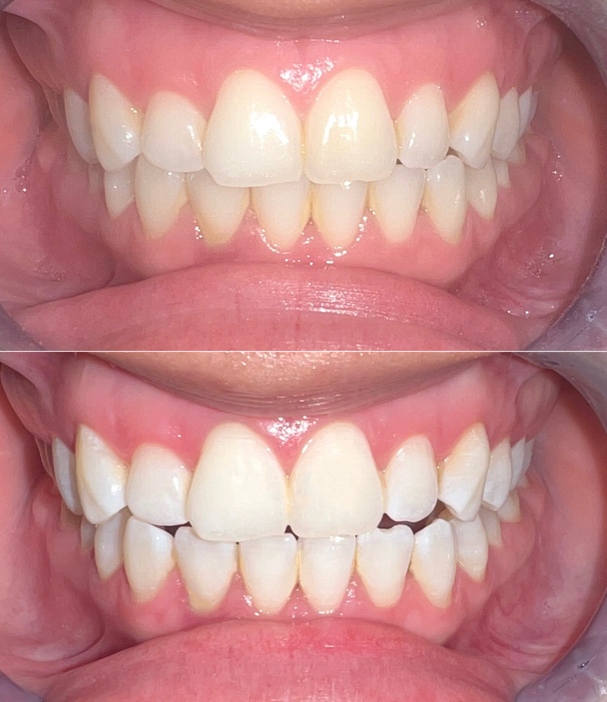 Teeth Whitening