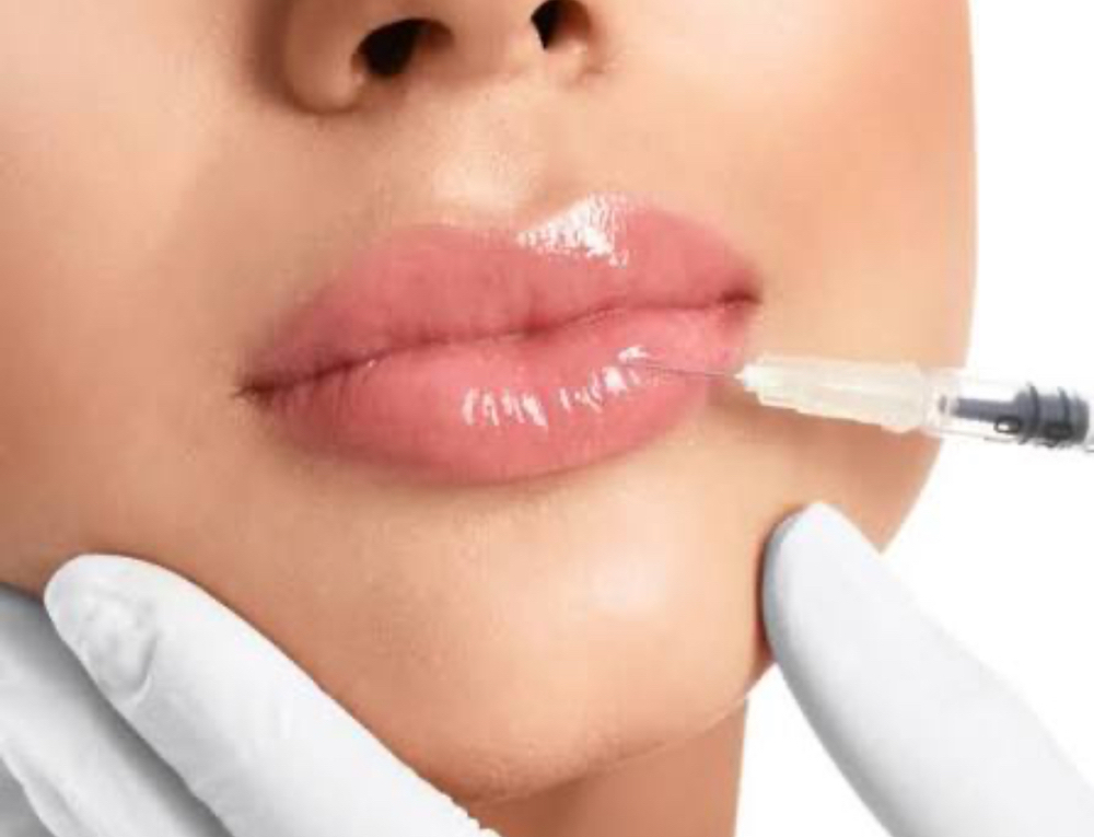 Lip Filler