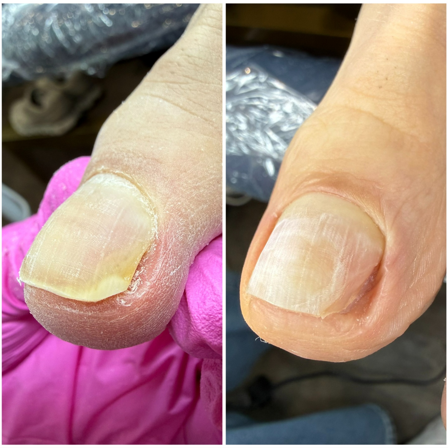 Toe Nail Debridement / Onycholysis at Naba Style Nails in McKinney, TX