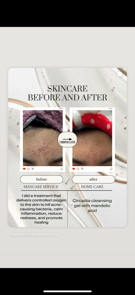 Oxygen/ Acne Clearing Facial