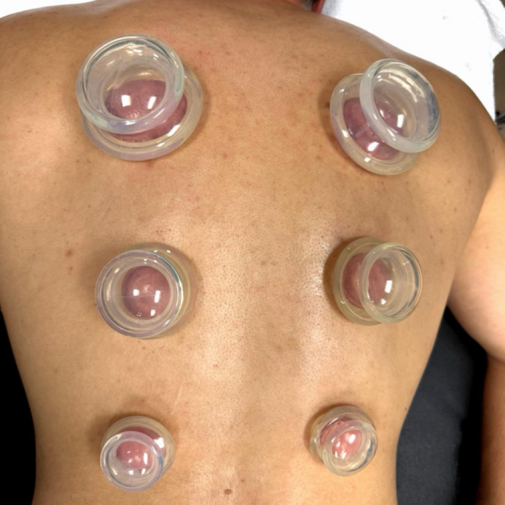 Cupping Therapy at Sol & Skin Wellness in Duncanville, TX