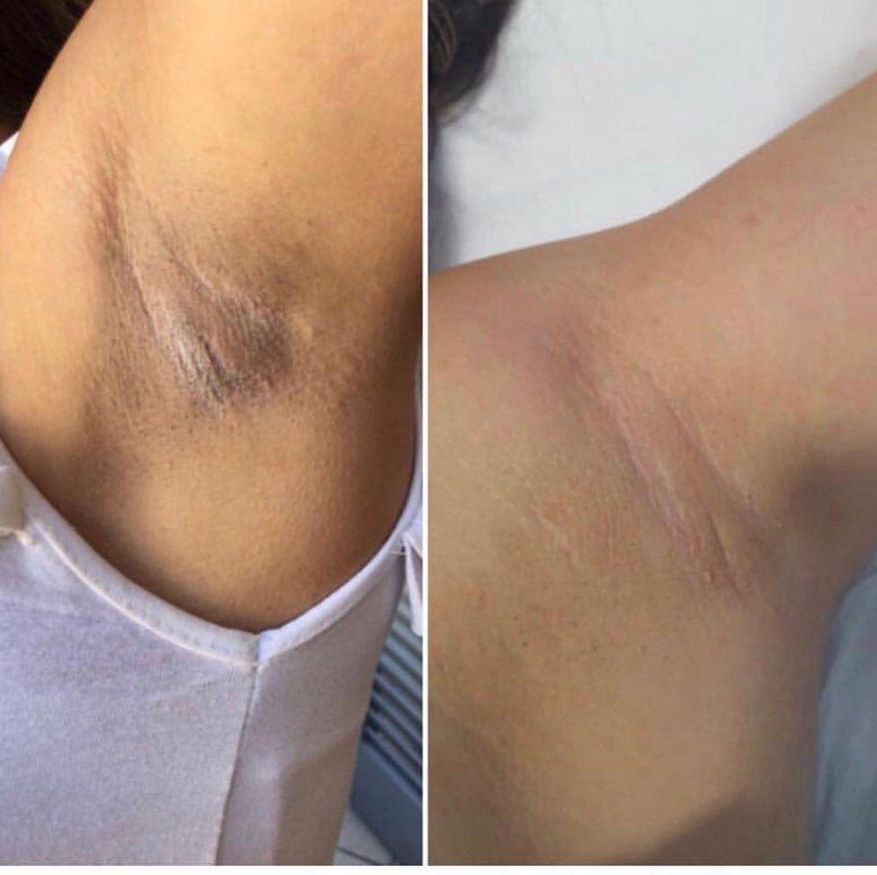 Intima peelings/ Zonas Intimas