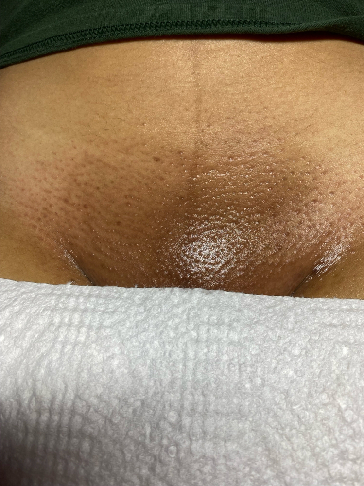 Bikini Full at Bare Beauty Waxing ,LLC in Bridgeport, CT