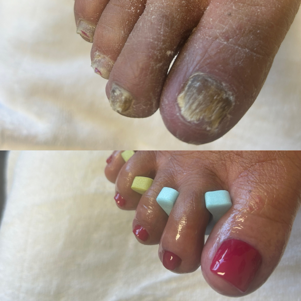 Toenail Restoration With Pedicure