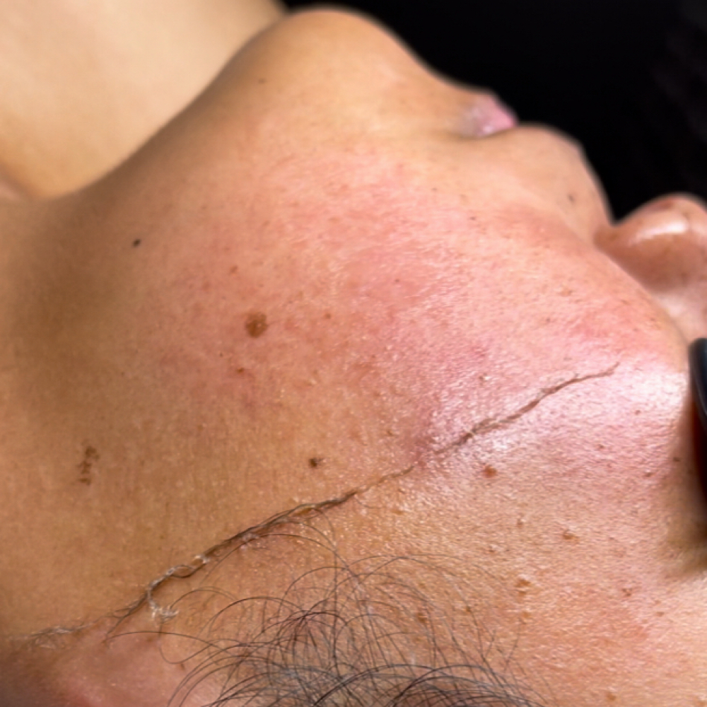 Dermaplaning at Radiance Aesthetics by Aracely in Bakersfield, CA