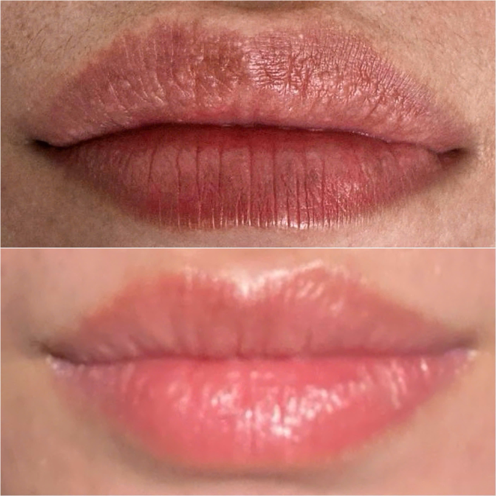 Lip Wrinkle Removal