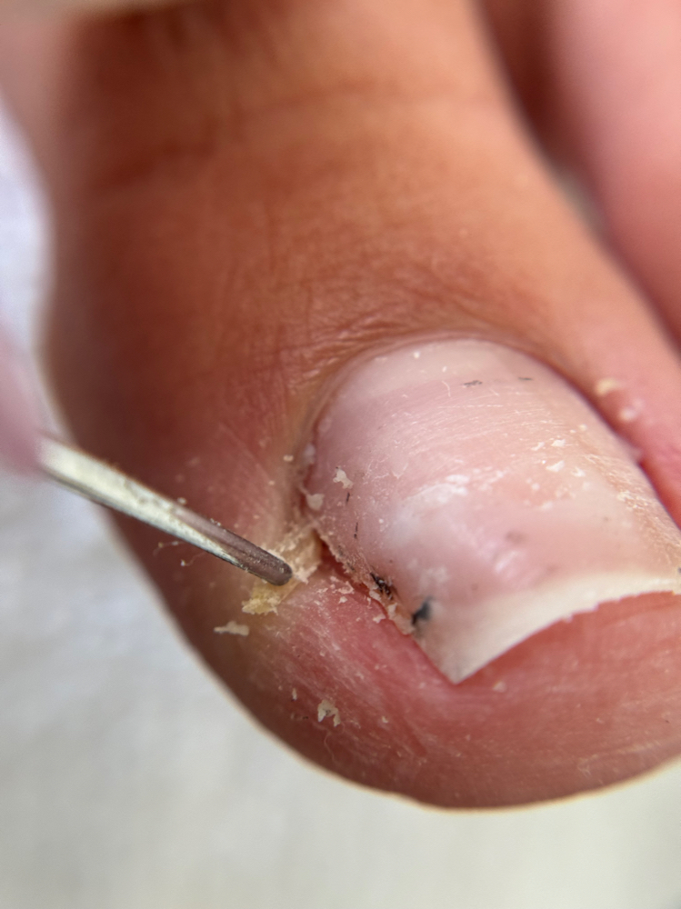 Ingrown Toenail Removal