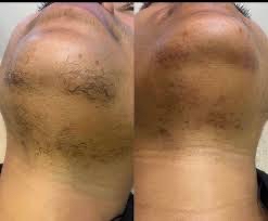 Chin Wax