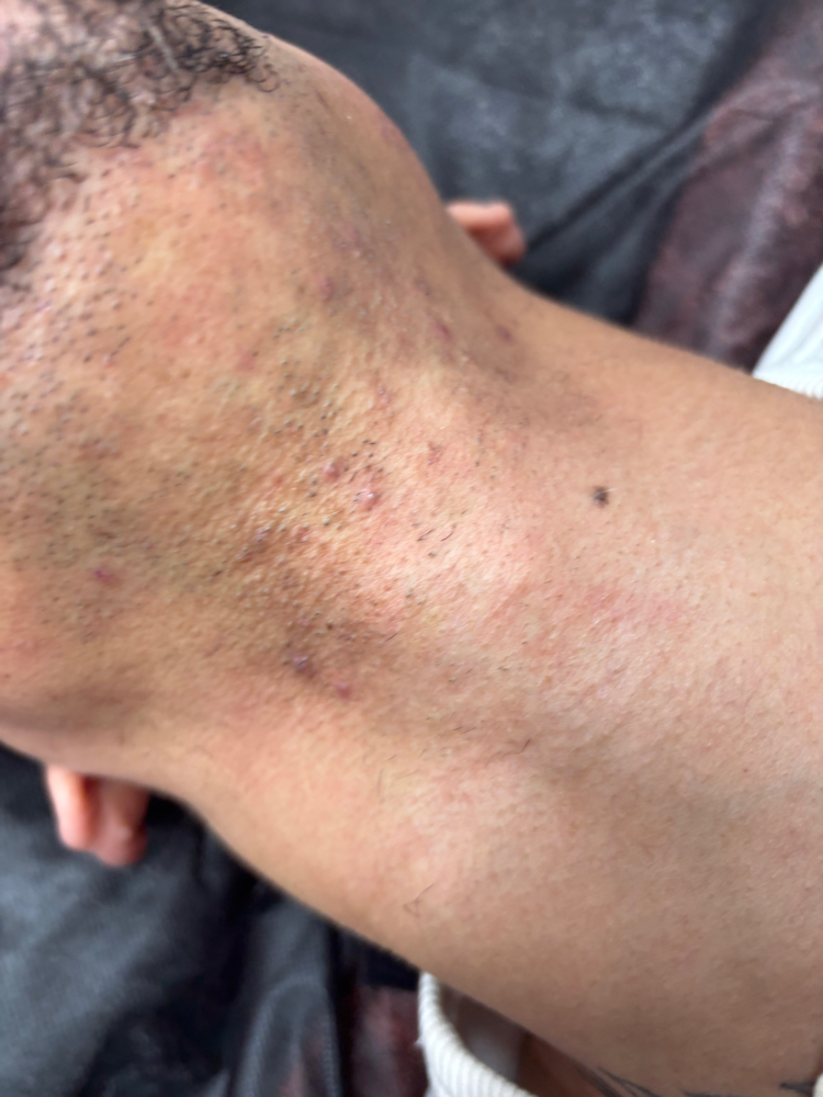 Lip Laser Hair Removal – $200 at Aestheticbylola in Bronx, NY