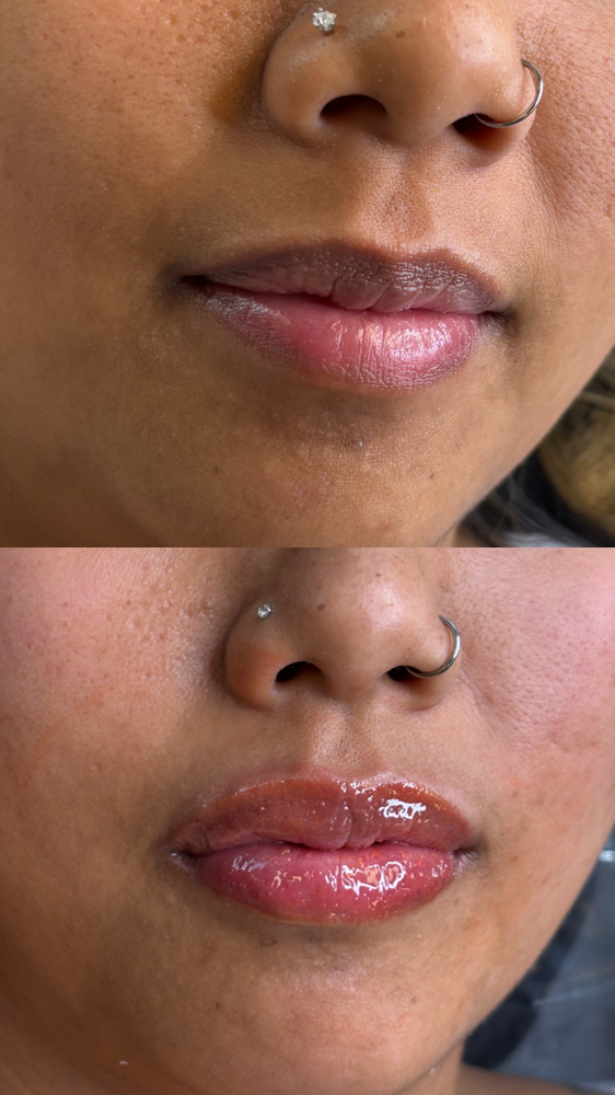 Lip Neutralization at Estheticallylei in Las Vegas, NV
