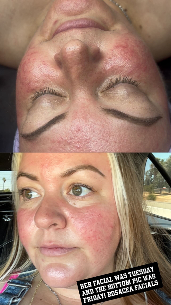 Rosacea facials