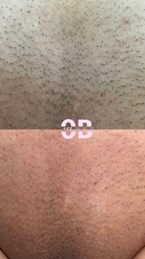 Laser Brazilian/ La Cuca