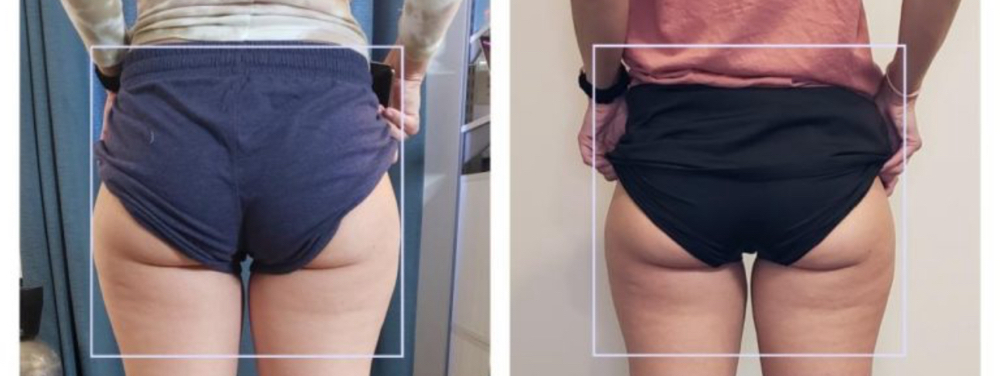 Inner Thighs Sculpt Cryo Med at VINE Studios Permanent Cosmetics in Maple Valley Wa, WA