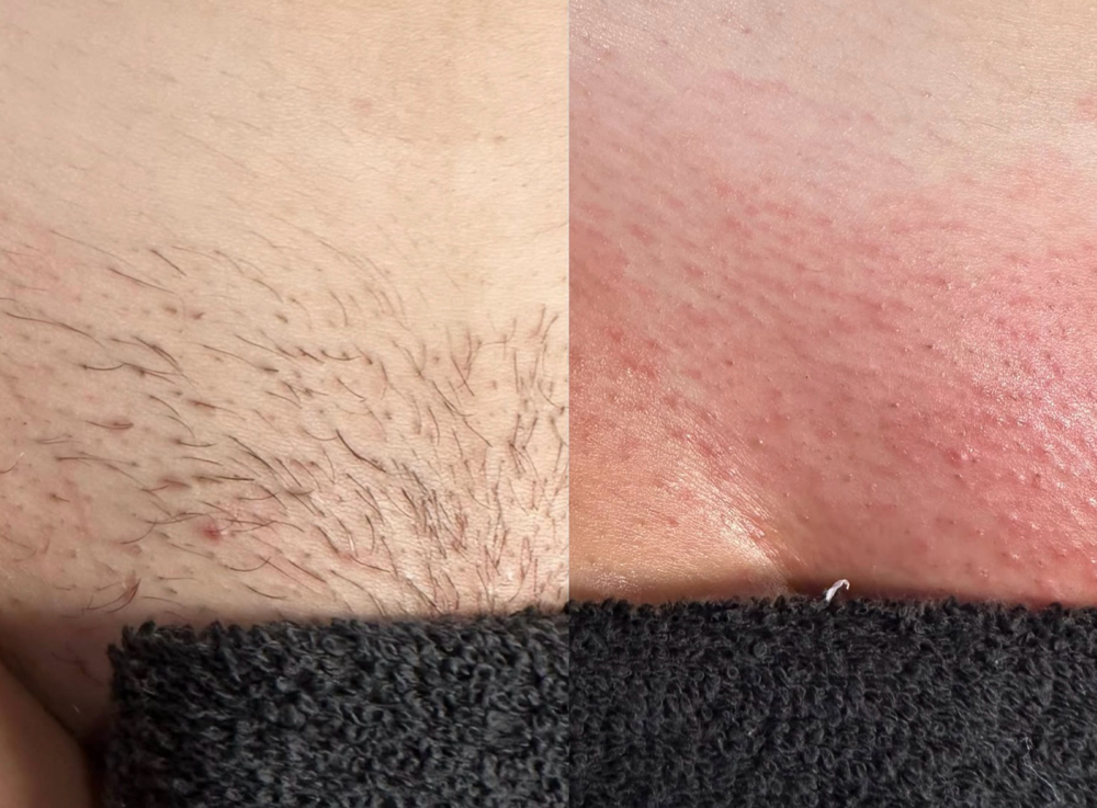 Bikini Line Wax