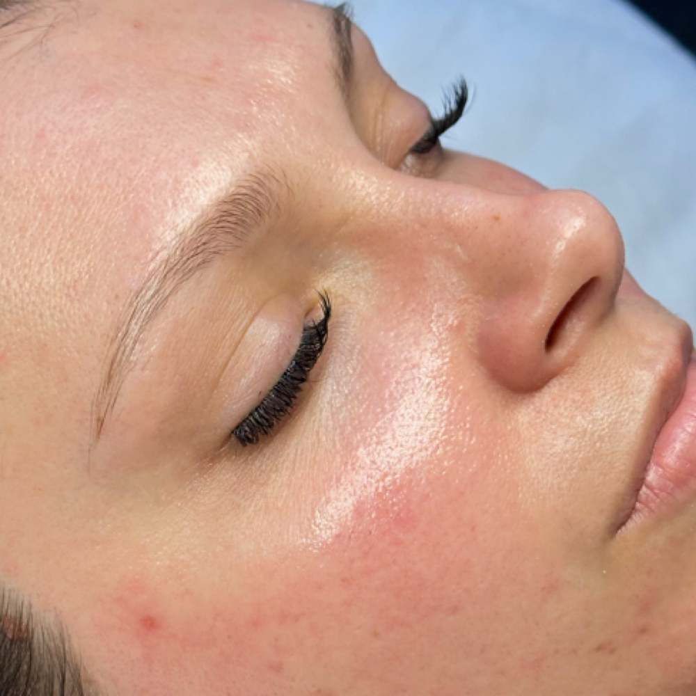 Dermaplane at Skin Academy in New Bedford, MA