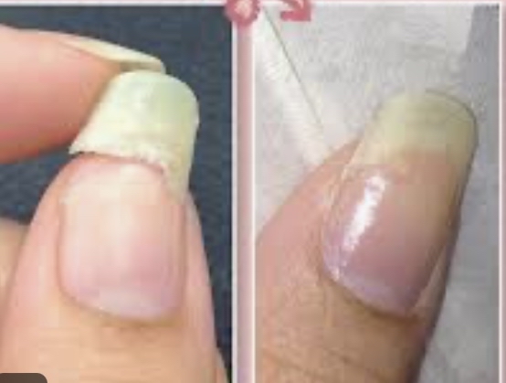 Nail Repair