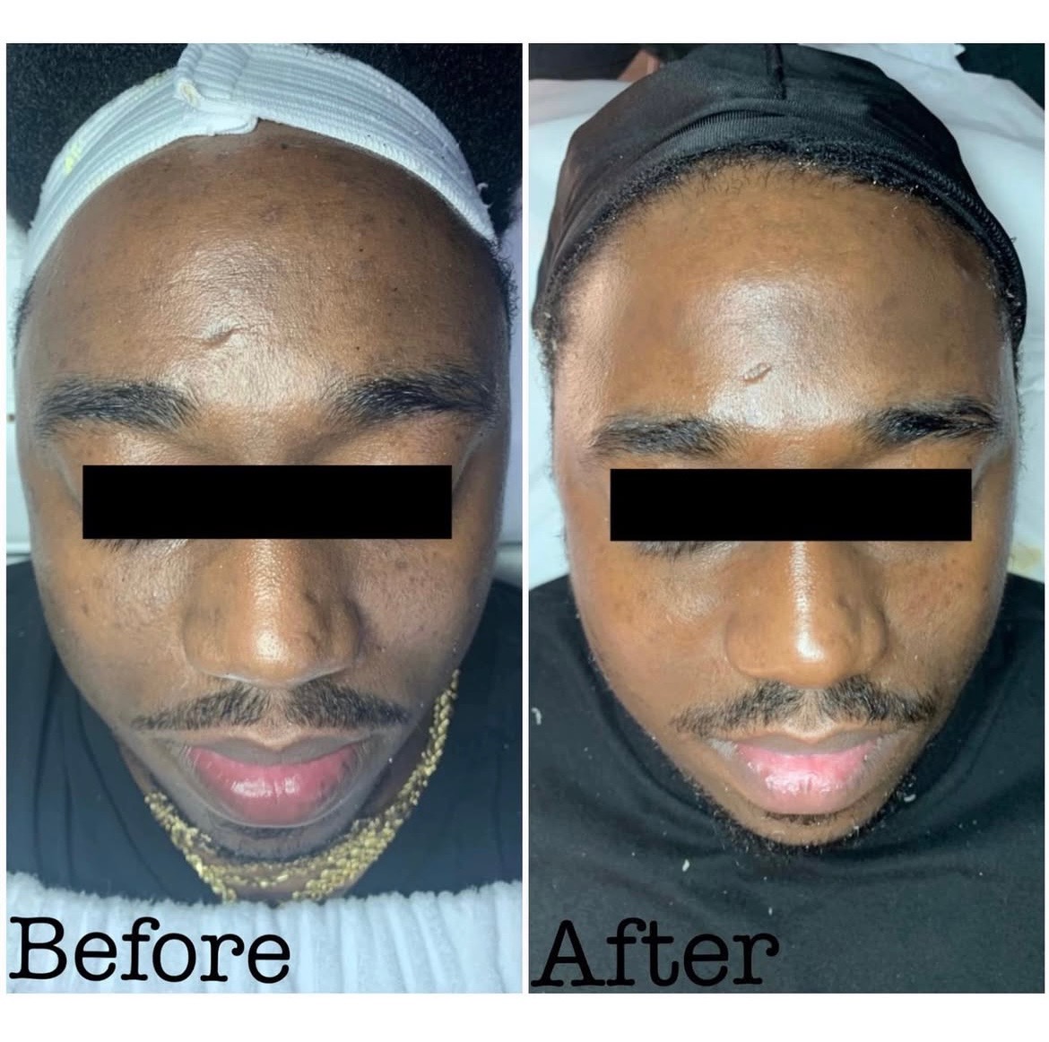 Microdermabrasion