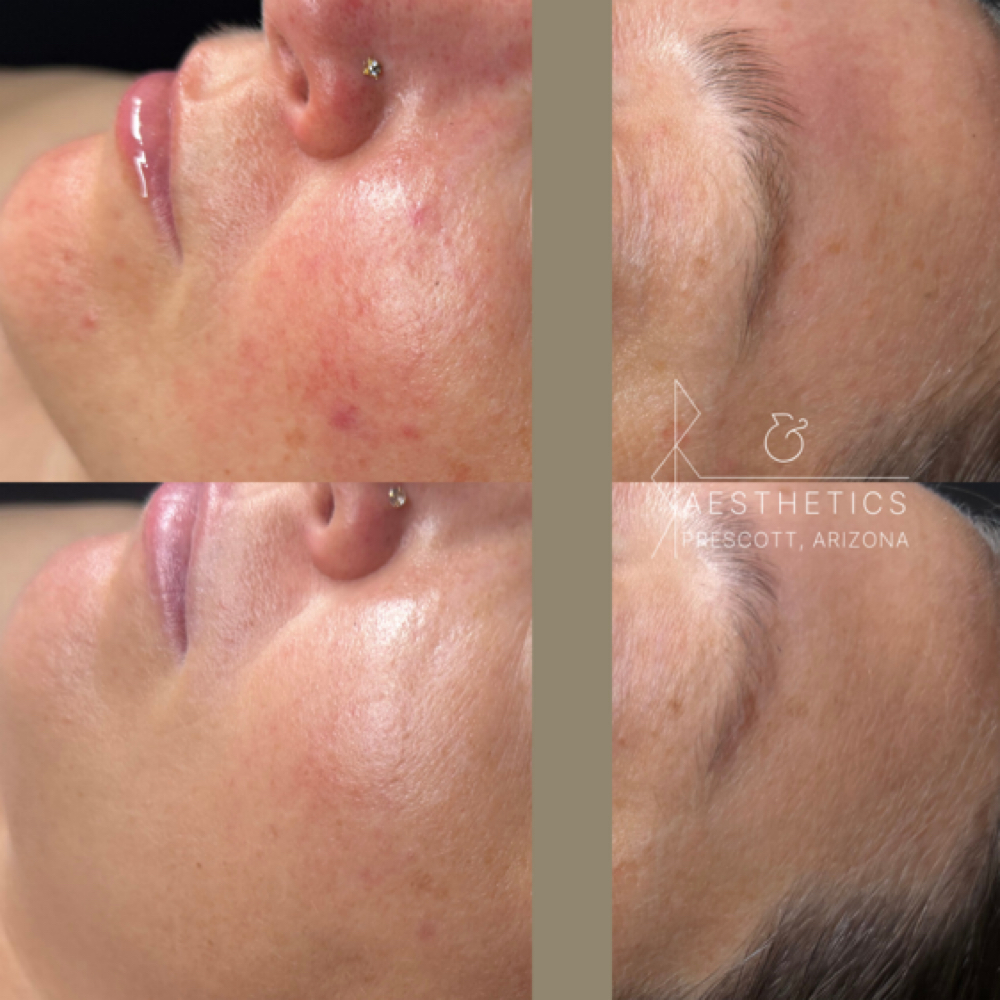 Bronze Acne Peel (Tier 1) at R&R Aesthetics - Prescott, Arizona in Prescott, AZ
