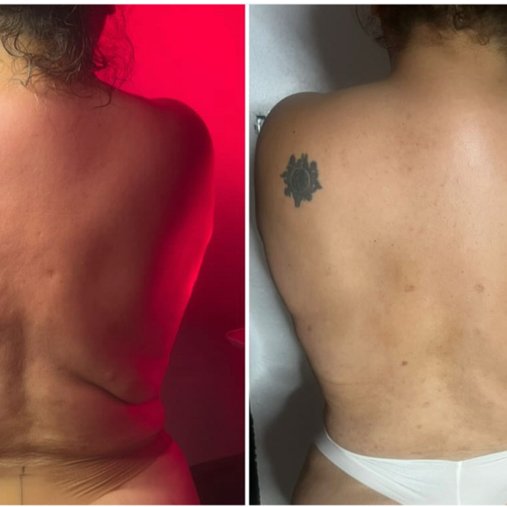 Lipo Lab Fat Dissove Shots at Pure Bliss Studios in Fort worth, TX