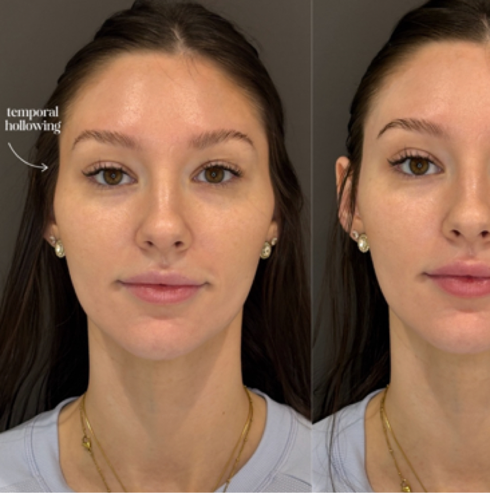 ✨ TEMPLE FILLER at Flawless Spa & Beauty in Fort Worth, TX