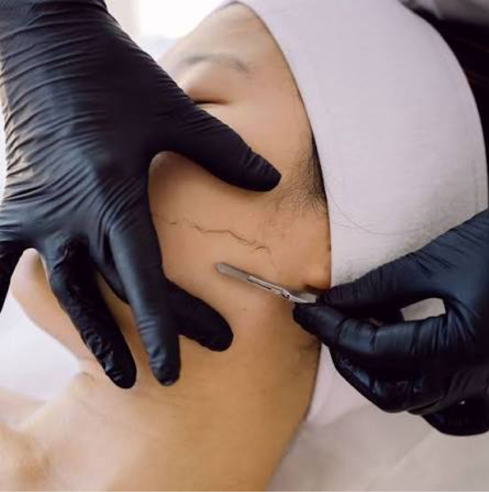 Dermaplane at Skin Deep Esthetics in Mentor, OH