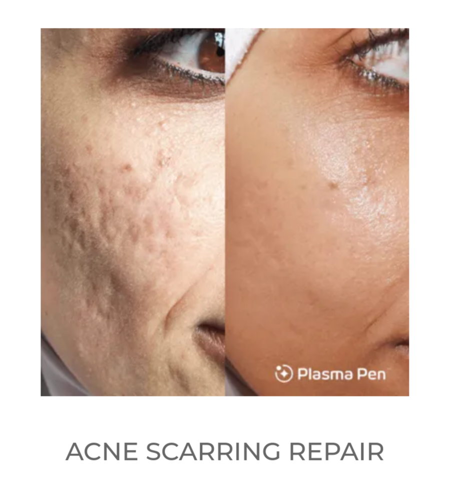 Acne Scarring Repair
