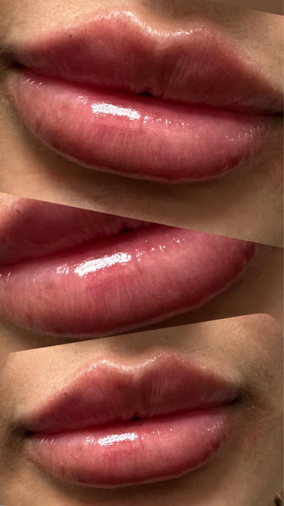 Lip Filler Injections (Restylane)