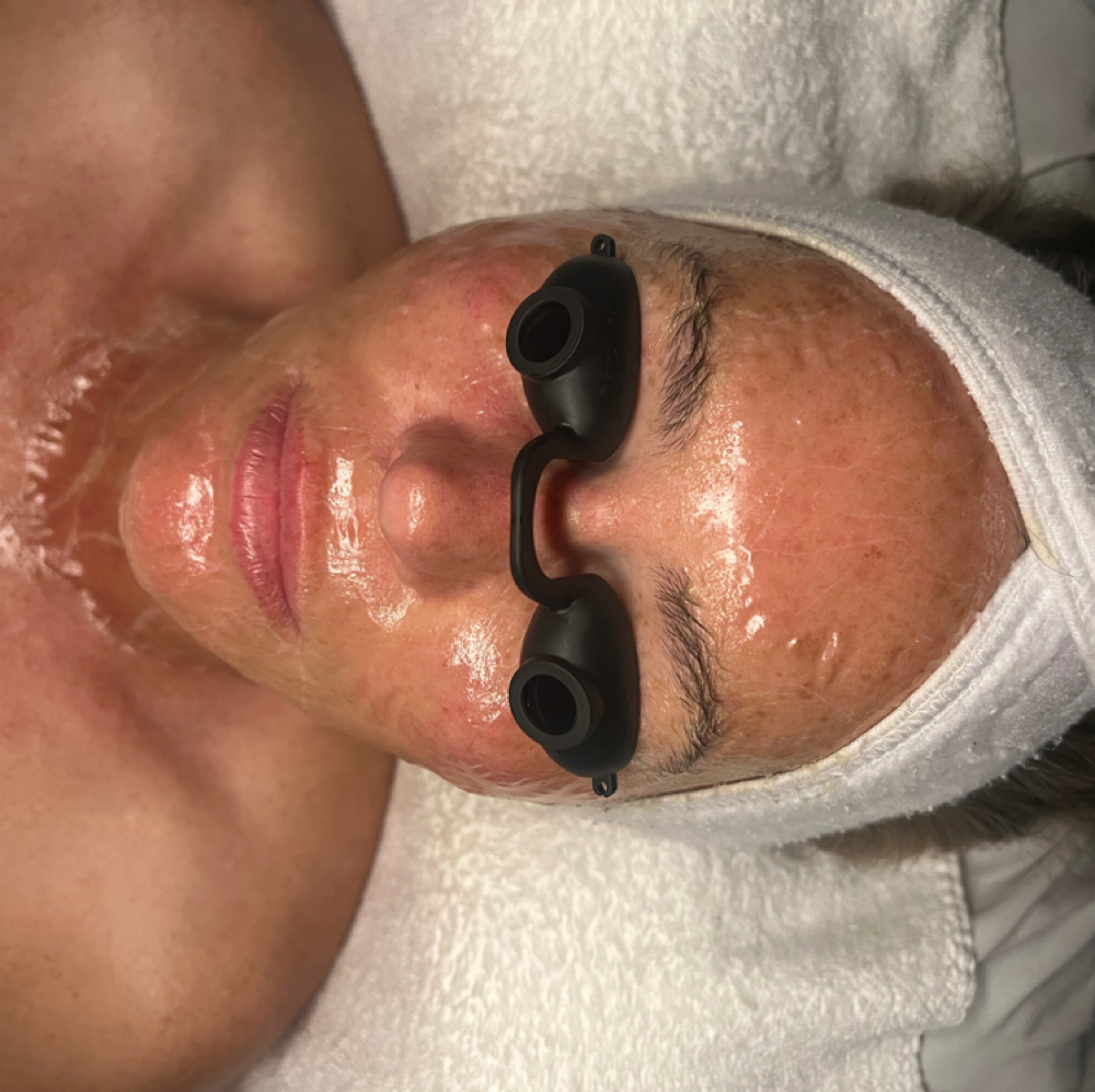 Beyond Botox Facial at Beauty by Nature in Surprise, AZ