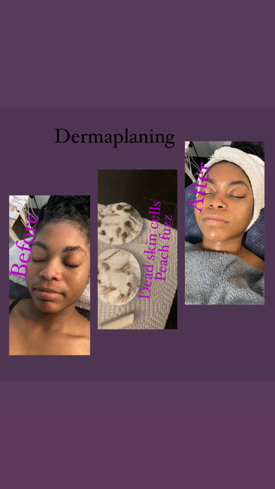 Dermaplane