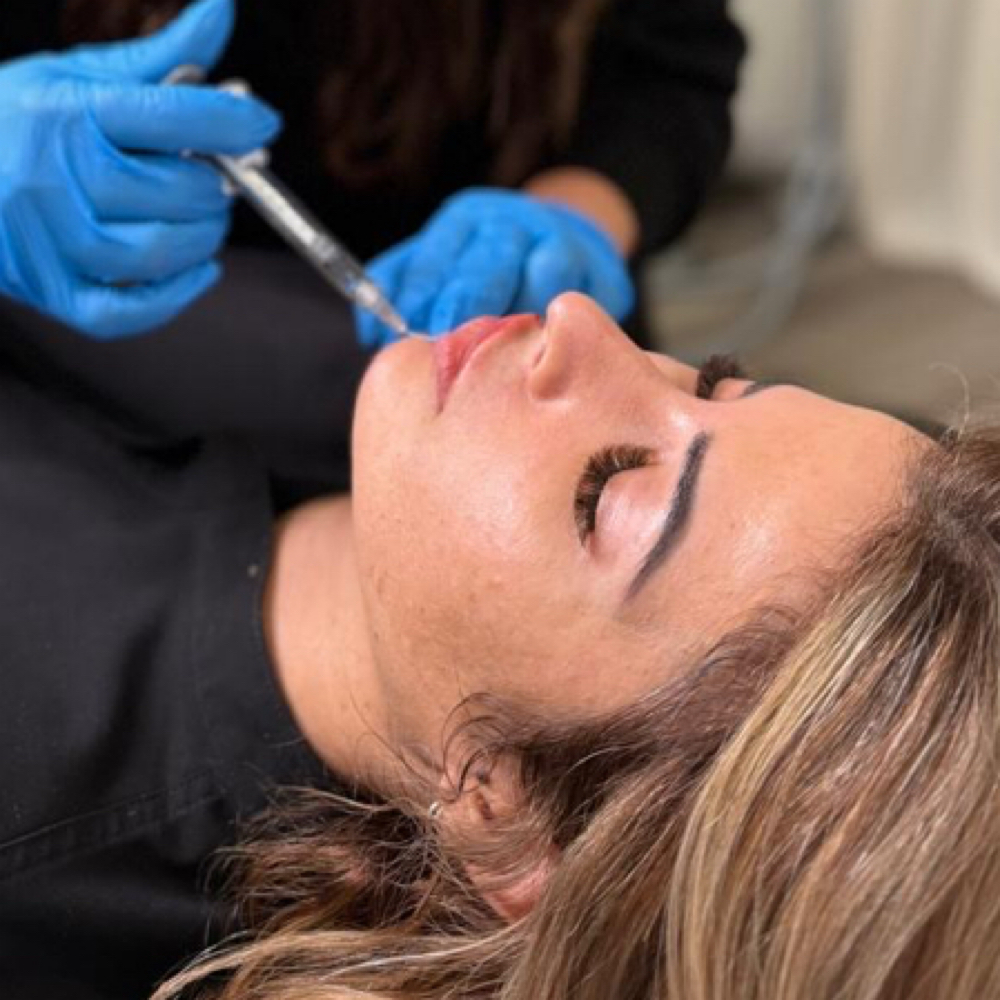 Derma Filler at U•Glow by Laura Mesa in Tampa, FL