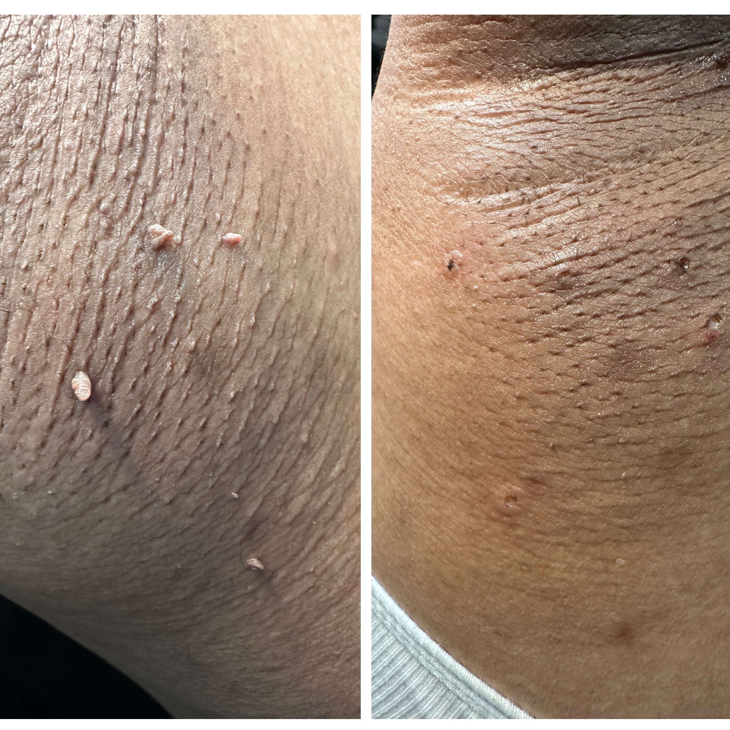 Skin Tag (Acrochordons) Removal at T&N Skin Med Spa Inc in Abington, PA