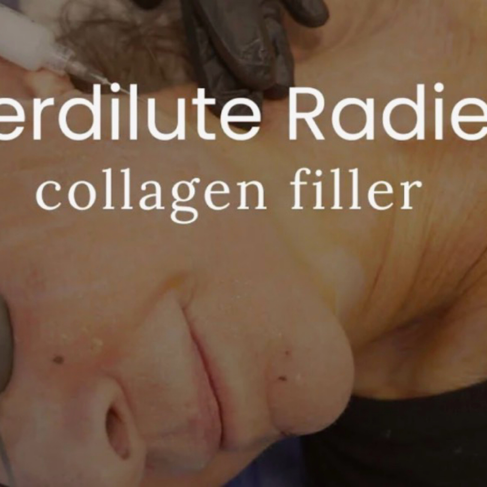 Hyperdilute Radiesse Collagen Biost at Jane aesthetics Med Spa in Pomona, CA