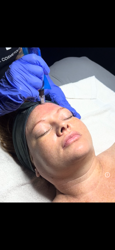 Radiance Microneedle (Series Of 3)