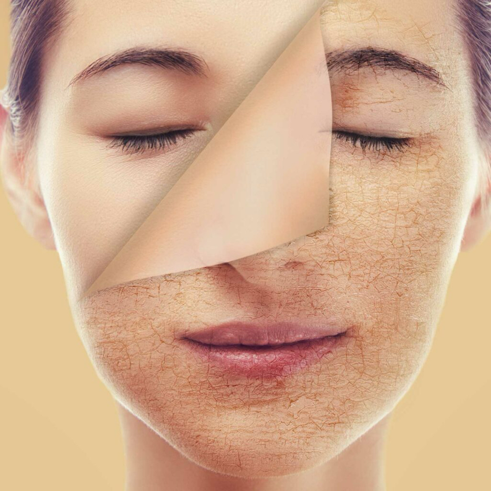 VI Chemical Peel at Golden Glow Aesthetics in Patterson, MO