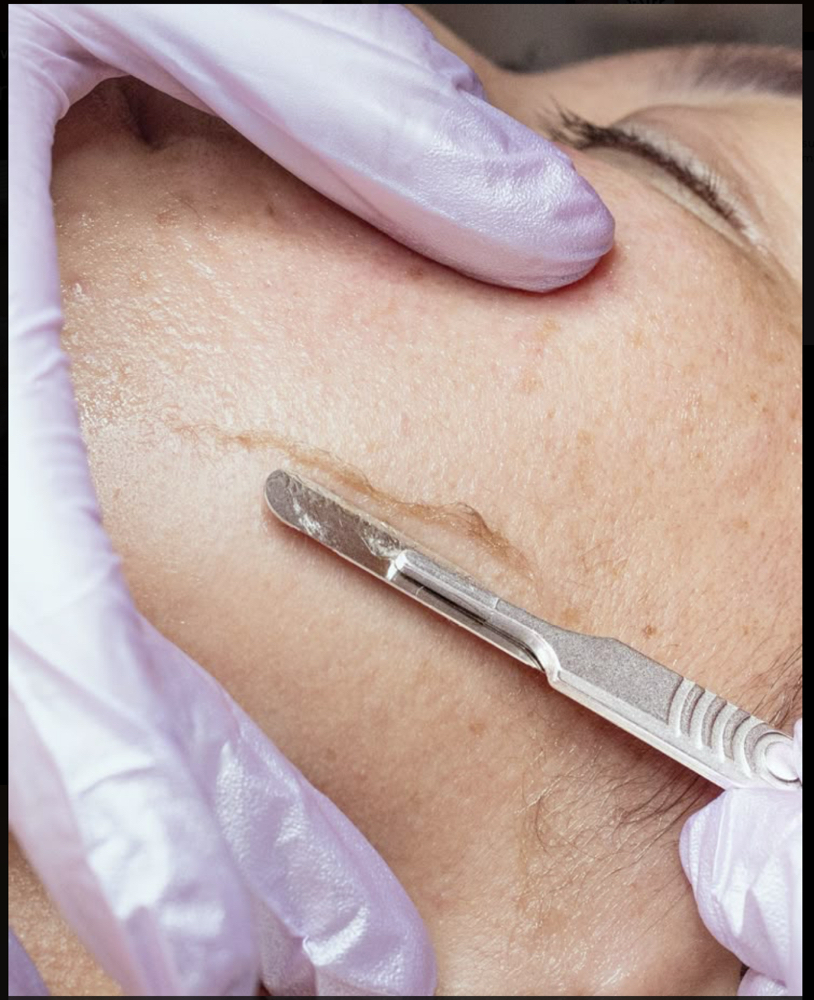 Dermplane Treatment at EstheticsbyMilanea in Rockford, IL