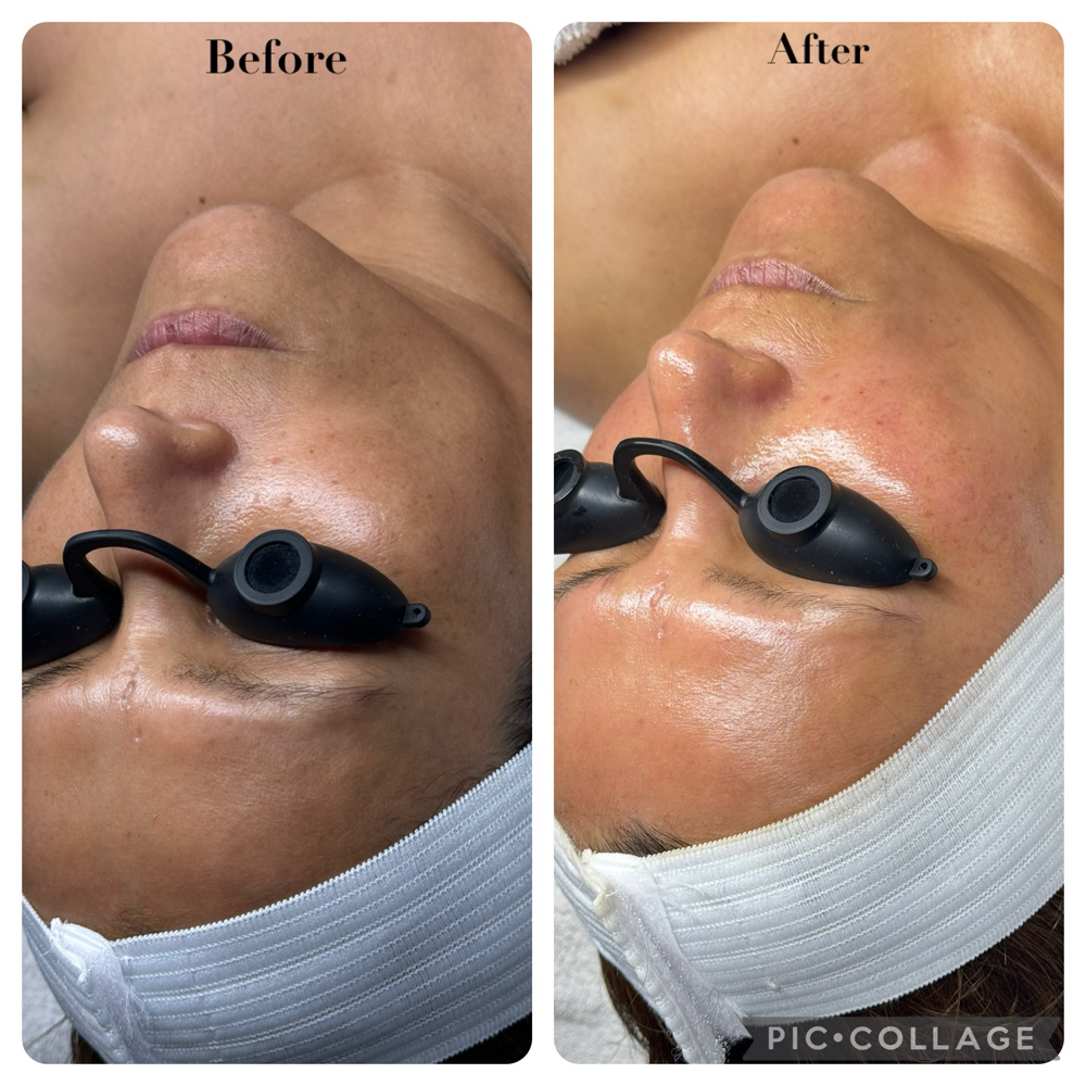 Refine and Recover Facial