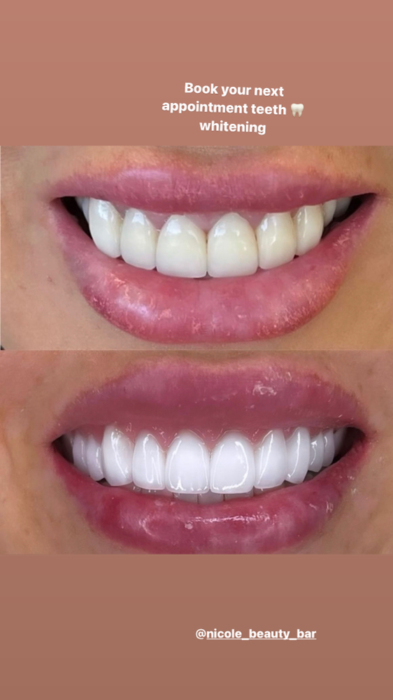 Teeth Whitening