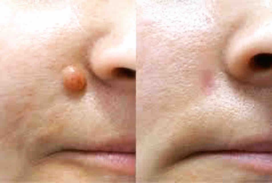 Skin Growth Removal