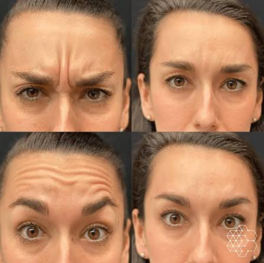 Botox at Studios Secrets in Dallas, TX