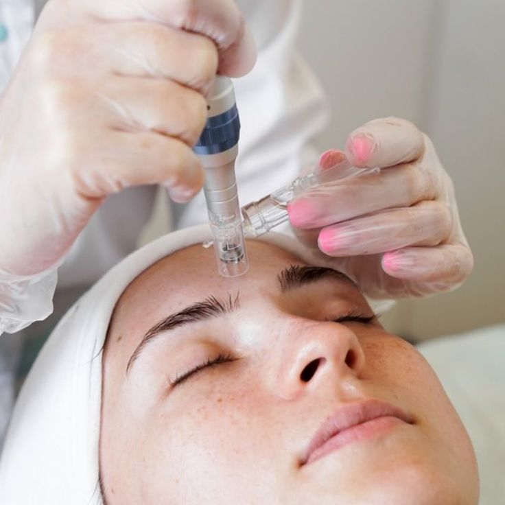 Microneedling facial