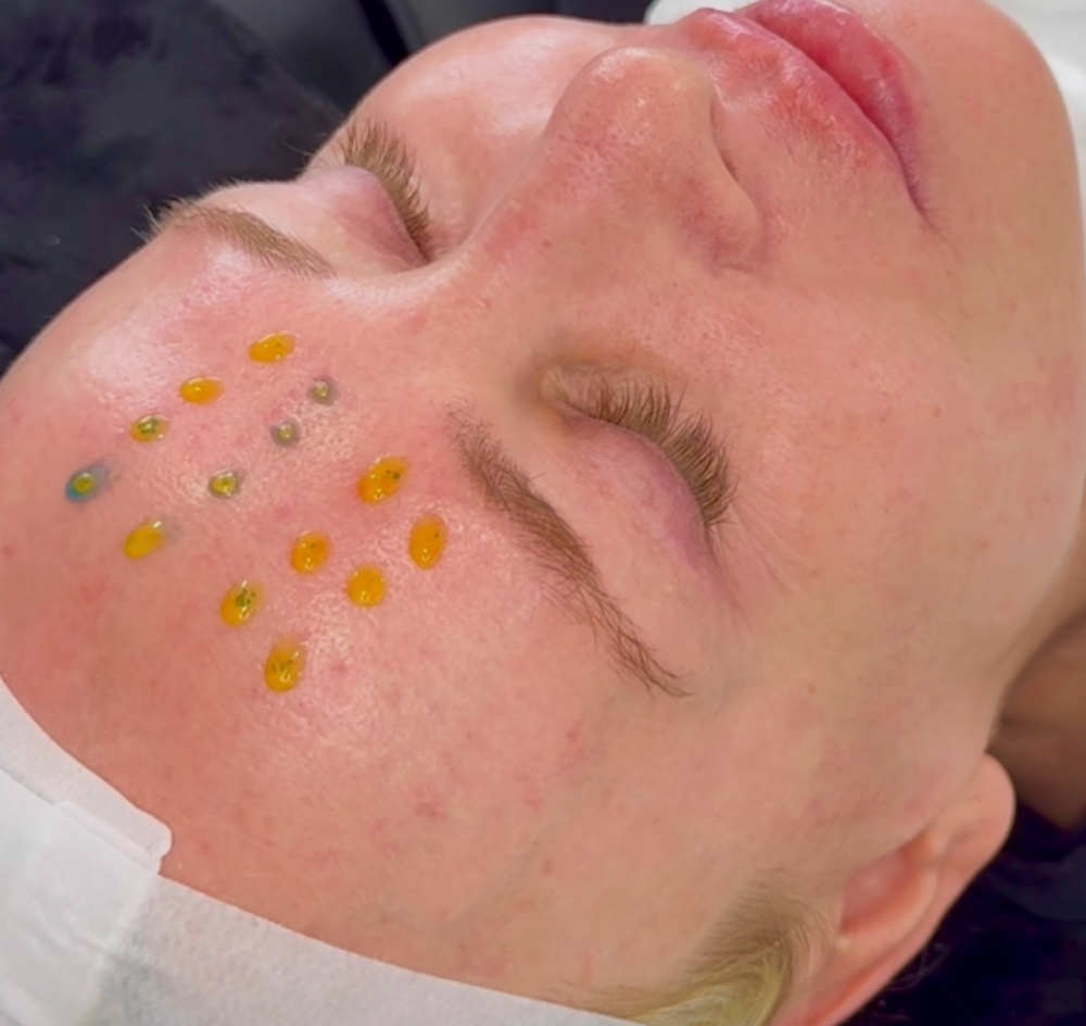 BioRepeel Facial
