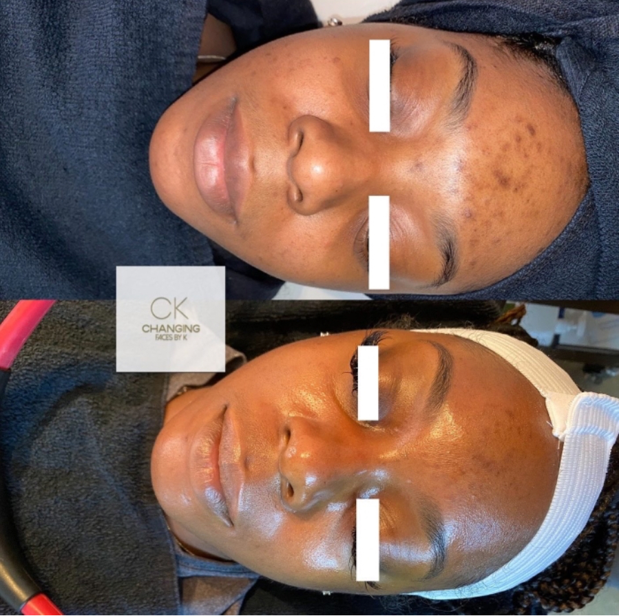 Diamond Microdermabrasion Facial