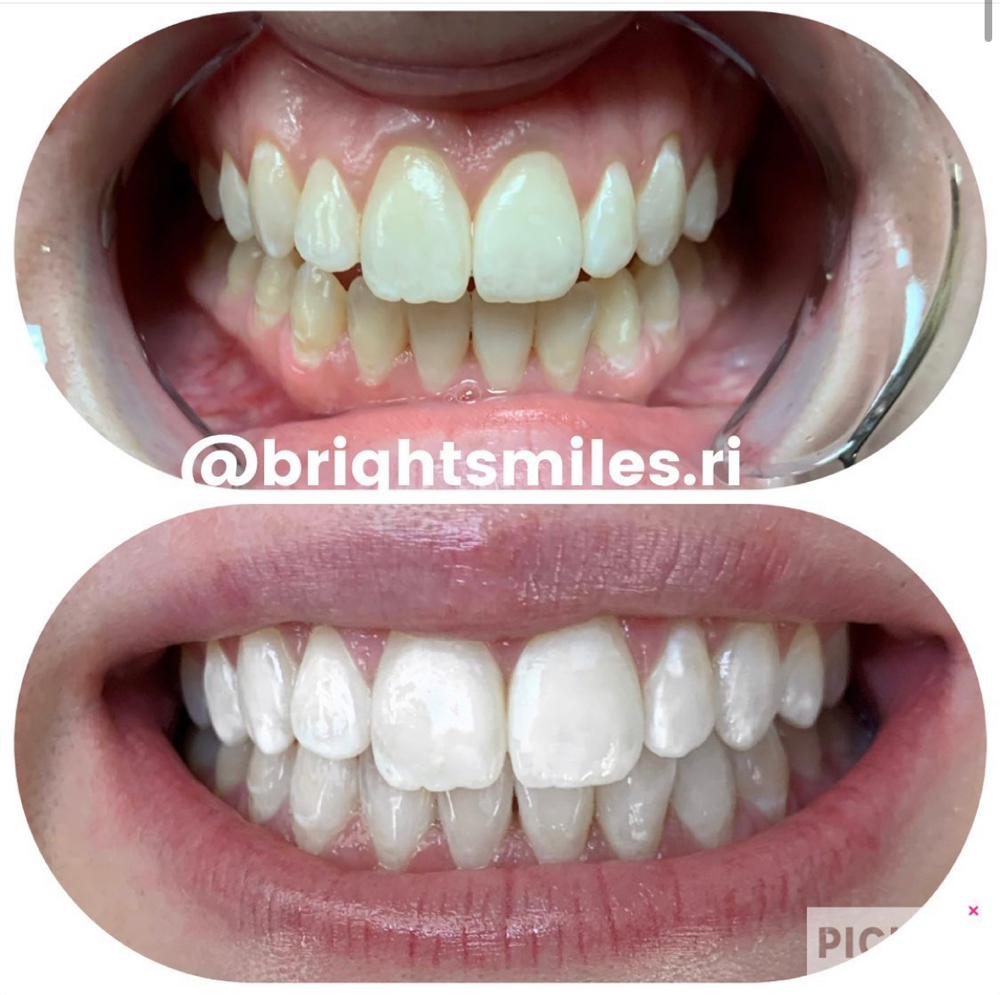 Teeth Whitening 45 Minute Session