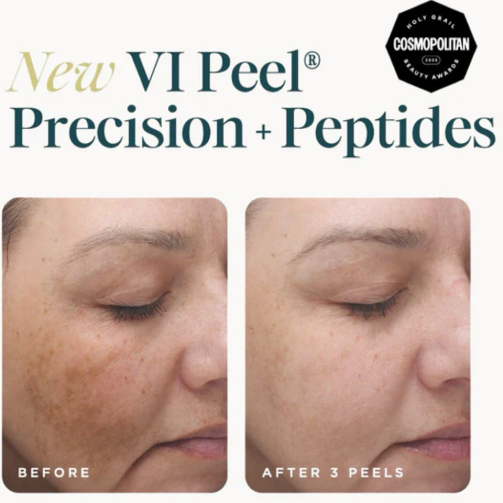 Vi Peel at Amy Donaldson Nurse Injector in Westport, MA